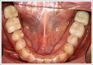 歯周外科処置（歯肉そうは術）治療後2