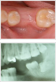 歯周外科処置（歯肉そうは術）治療前2