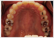 歯周外科処置（歯肉そうは術）治療前2