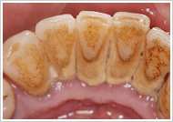 歯周治療（歯石の除去）治療前