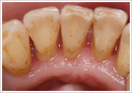 歯周治療（歯石の除去）治療後