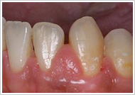 歯周外科処置（歯肉切除術）治療前