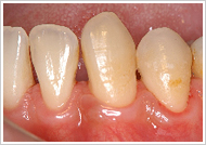 歯周外科処置（歯肉切除術）治療後