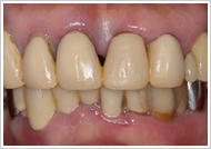 歯周外科処置（歯肉そうは術）治療前1