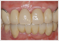 歯周外科処置（歯肉そうは術）治療後1