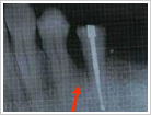 歯周外科処置（骨再生療法術）治療前2