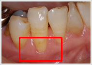 歯周形成外科処置（根面被覆術）治療前
