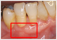 歯周形成外科処置（根面被覆術）治療後