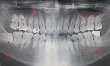 お口のレントゲン写真