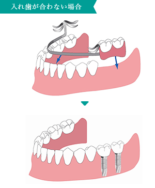 入れ歯が合わない場合