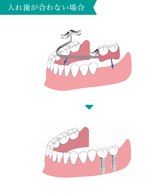入れ歯が合わない場合
