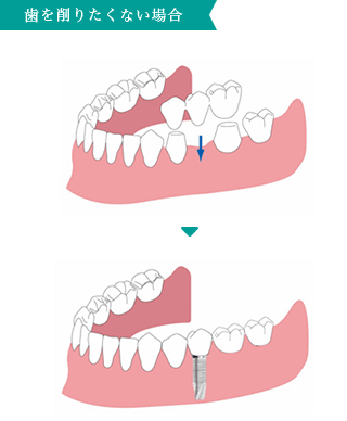 歯を削りたくない場合