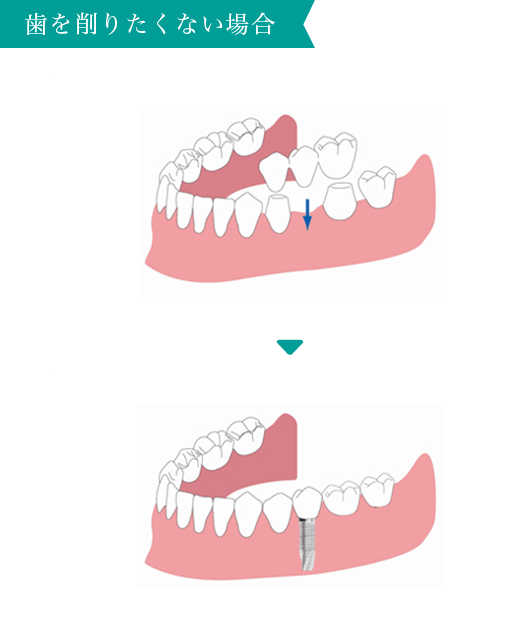 歯を削りたくない場合