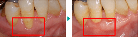 歯周形成外科処置