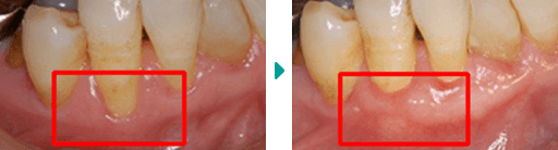 歯周形成外科処置