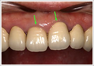 オールセラミッククラウン2治療前