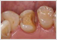 ハイブリッドセラミッククラウン治療中