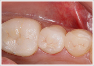 オールセラミックインレー治療後