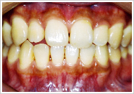 ホワイトニング治療前